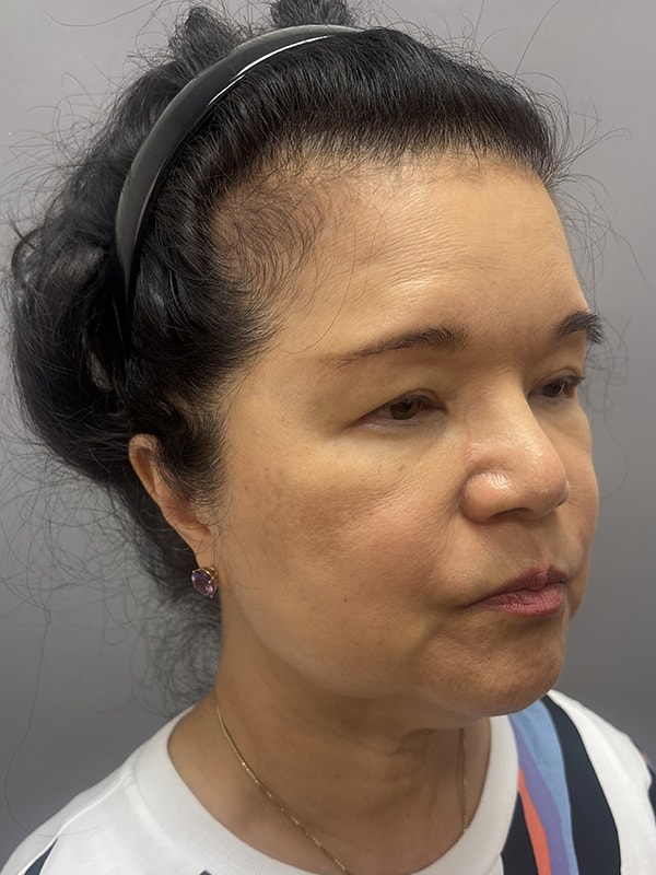 Neck Lift Before & After Image