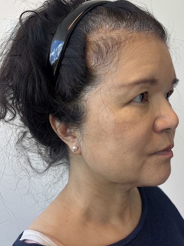 Neck Lift Before & After Image