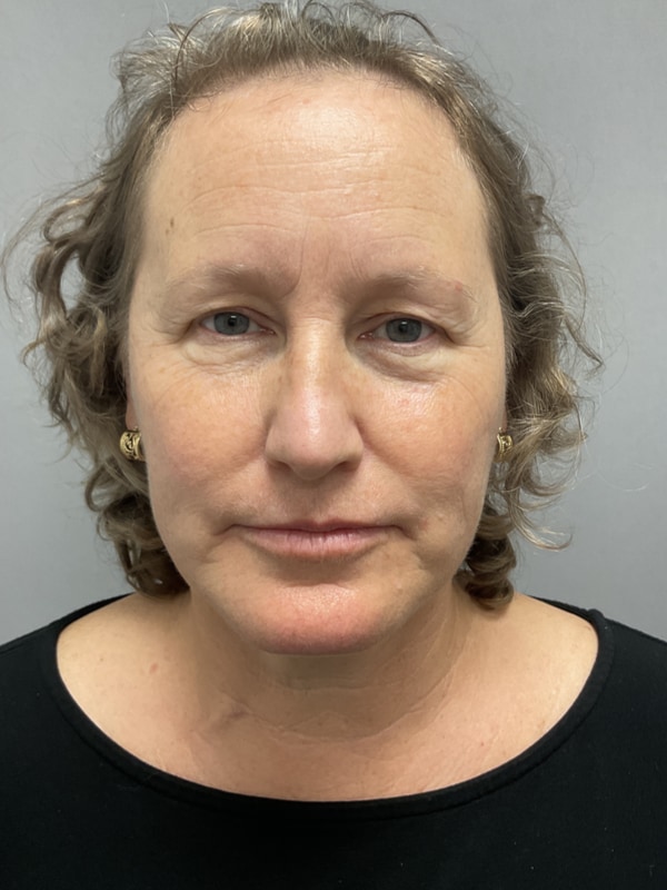 Neck Lift Before & After Image