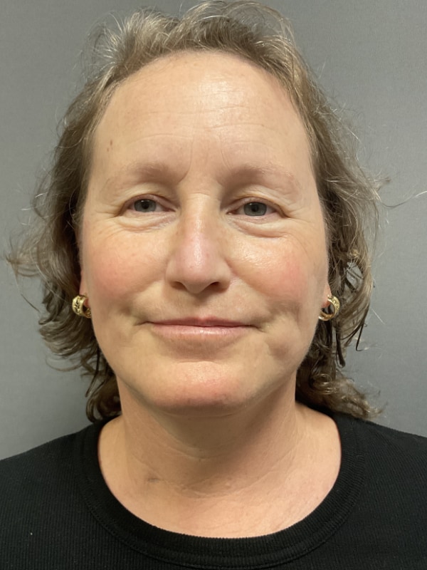 Neck Lift Before & After Image
