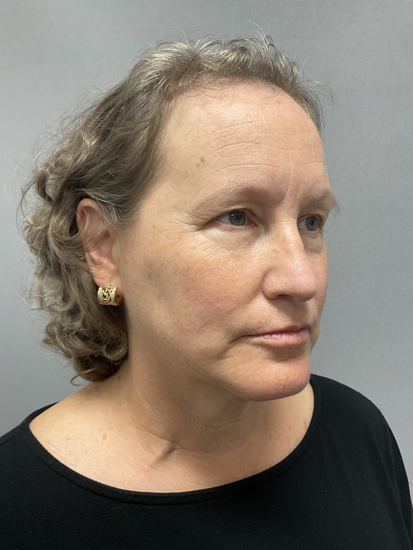 Neck Lift Before & After Image