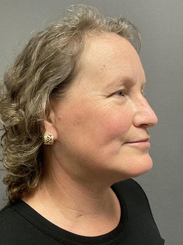 Neck Lift Before & After Image