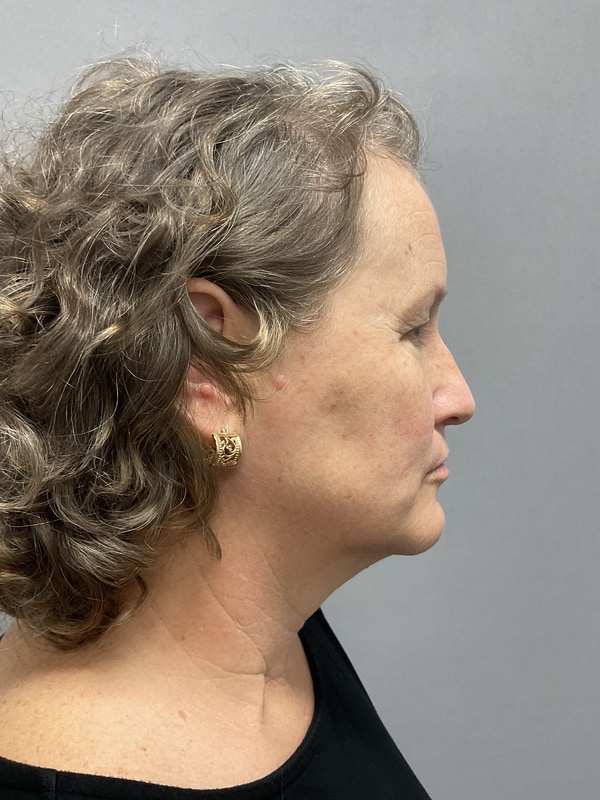Neck Lift Before & After Image