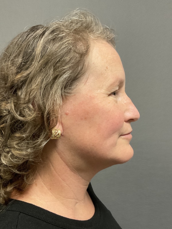 Neck Lift Before & After Image