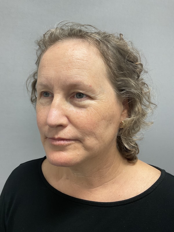 Neck Lift Before & After Image