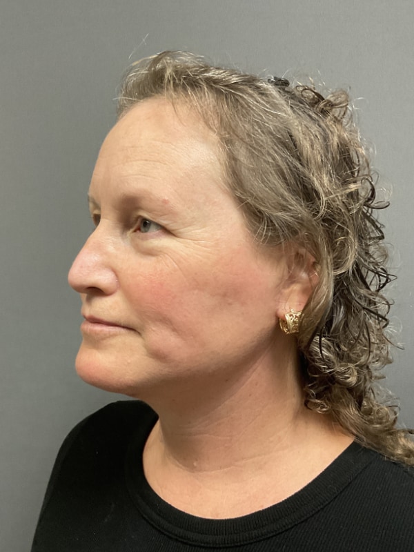 Neck Lift Before & After Image