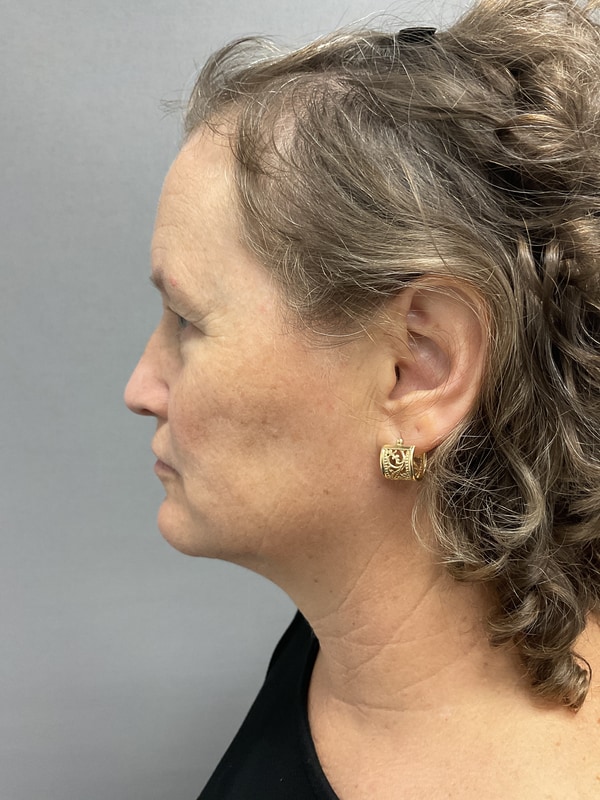 Neck Lift Before & After Image