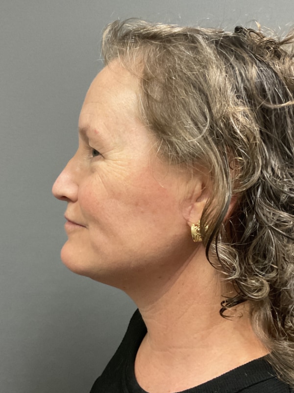 Neck Lift Before & After Image