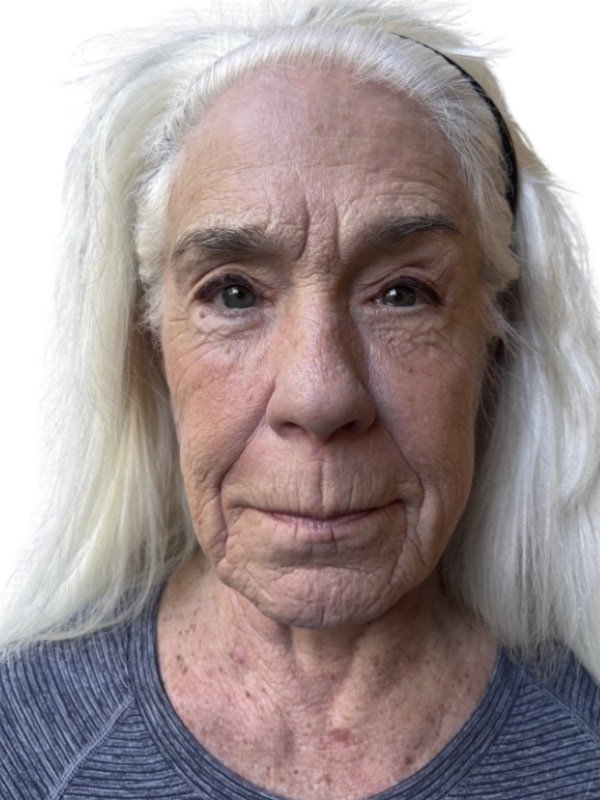Neck Lift Before & After Image