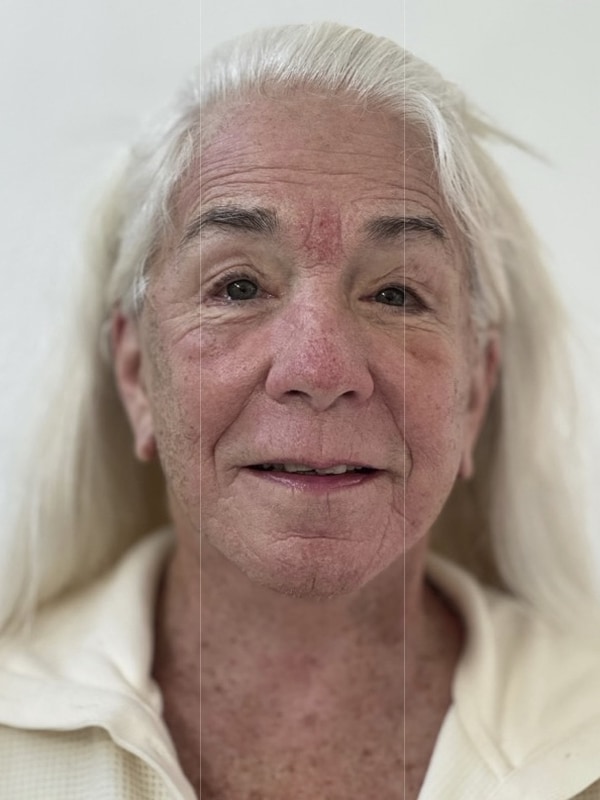 Neck Lift Before & After Image