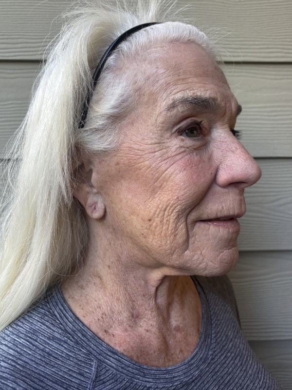 Neck Lift Before & After Image