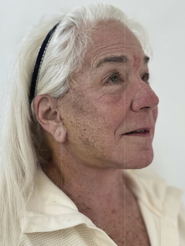Neck Lift Before & After Image