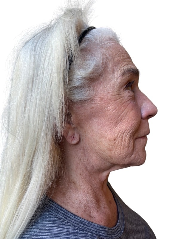 Neck Lift Before & After Image