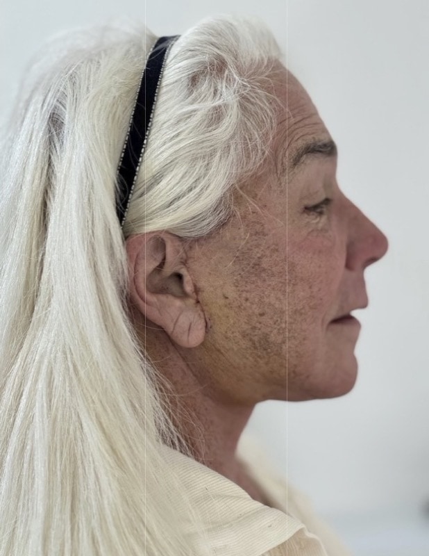 Neck Lift Before & After Image