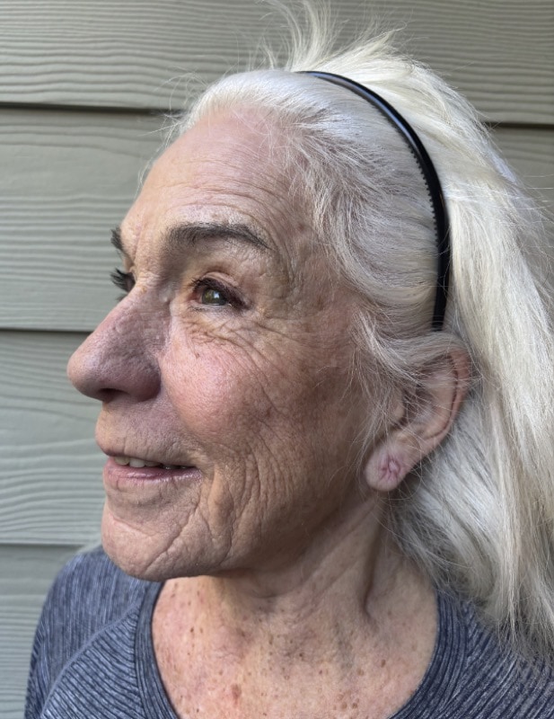 Neck Lift Before & After Image