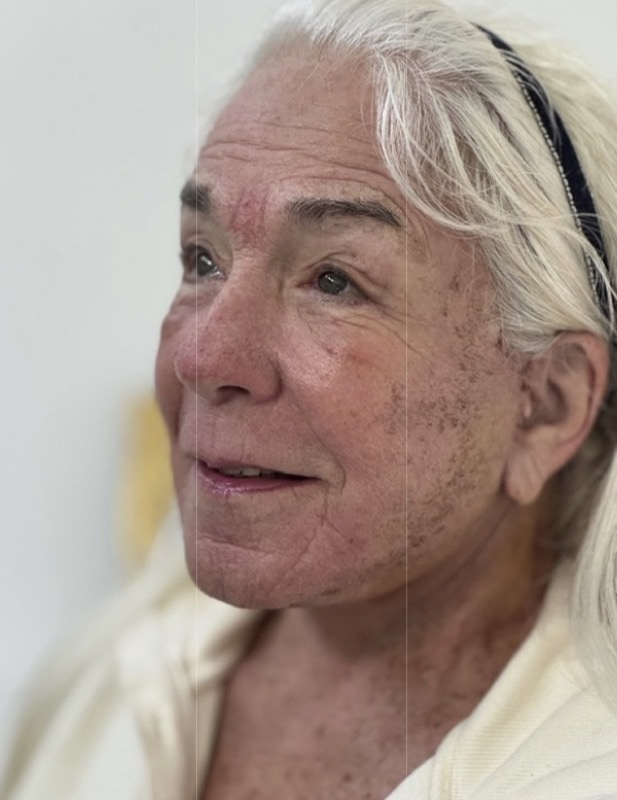 Neck Lift Before & After Image