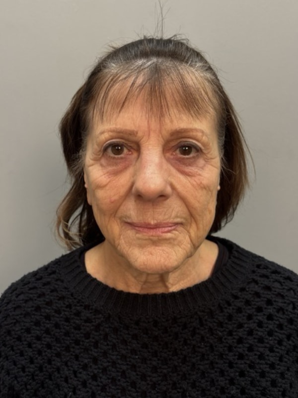Neck Lift Before & After Image