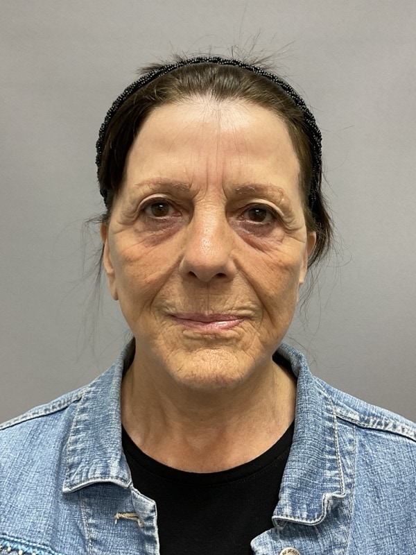 Neck Lift Before & After Image