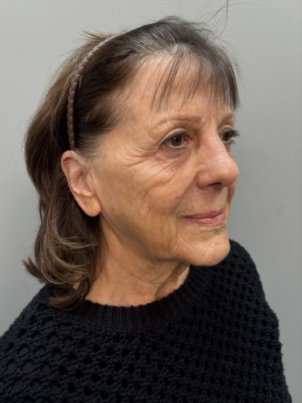 Neck Lift Before & After Image