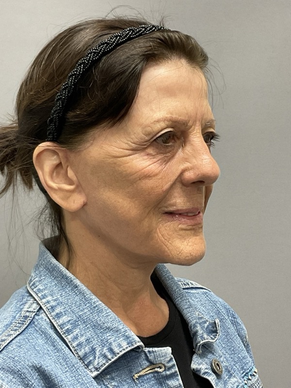 Neck Lift Before & After Image