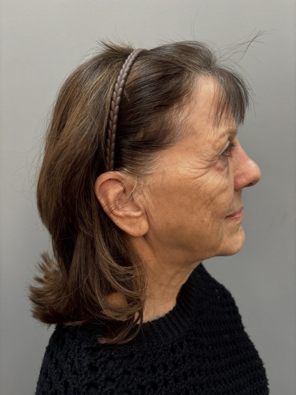 Neck Lift Before & After Image