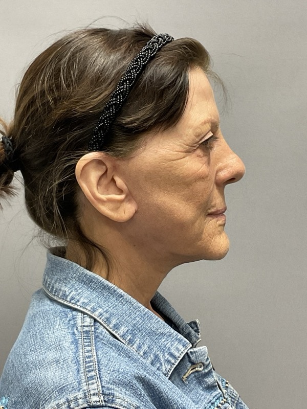 Neck Lift Before & After Image