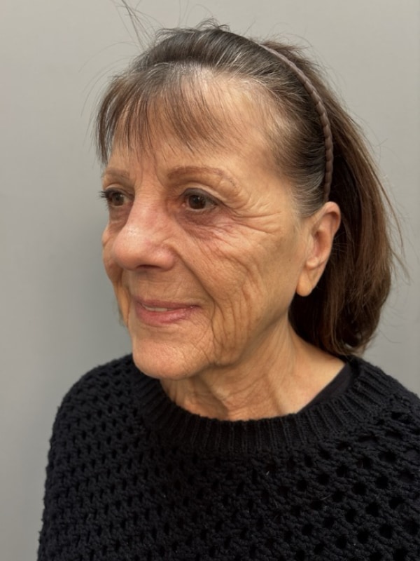 Neck Lift Before & After Image