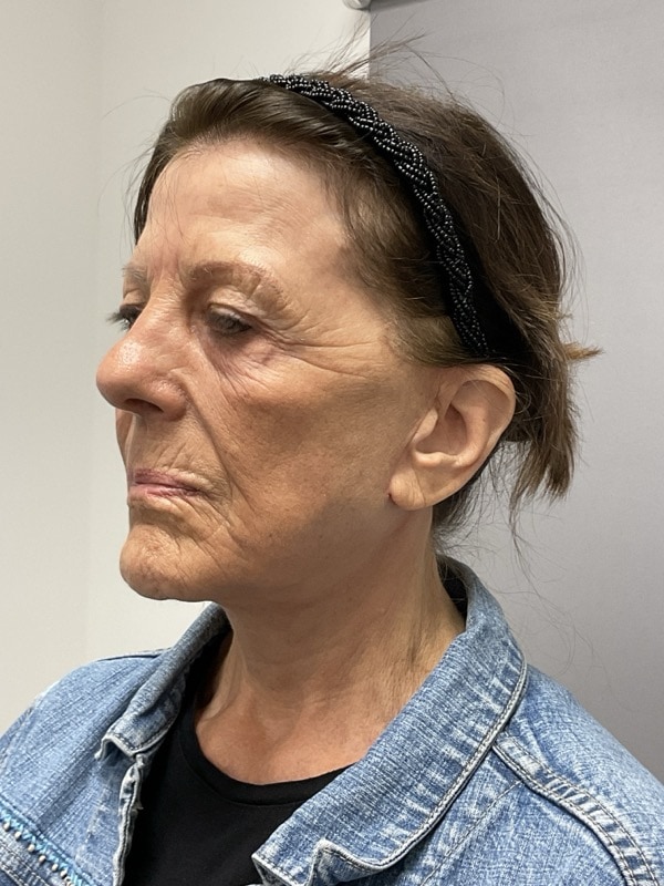Neck Lift Before & After Image