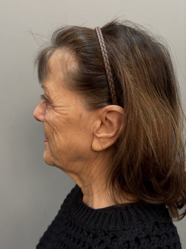 Neck Lift Before & After Image