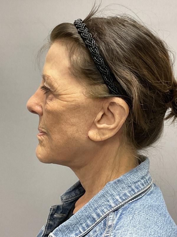 Neck Lift Before & After Image