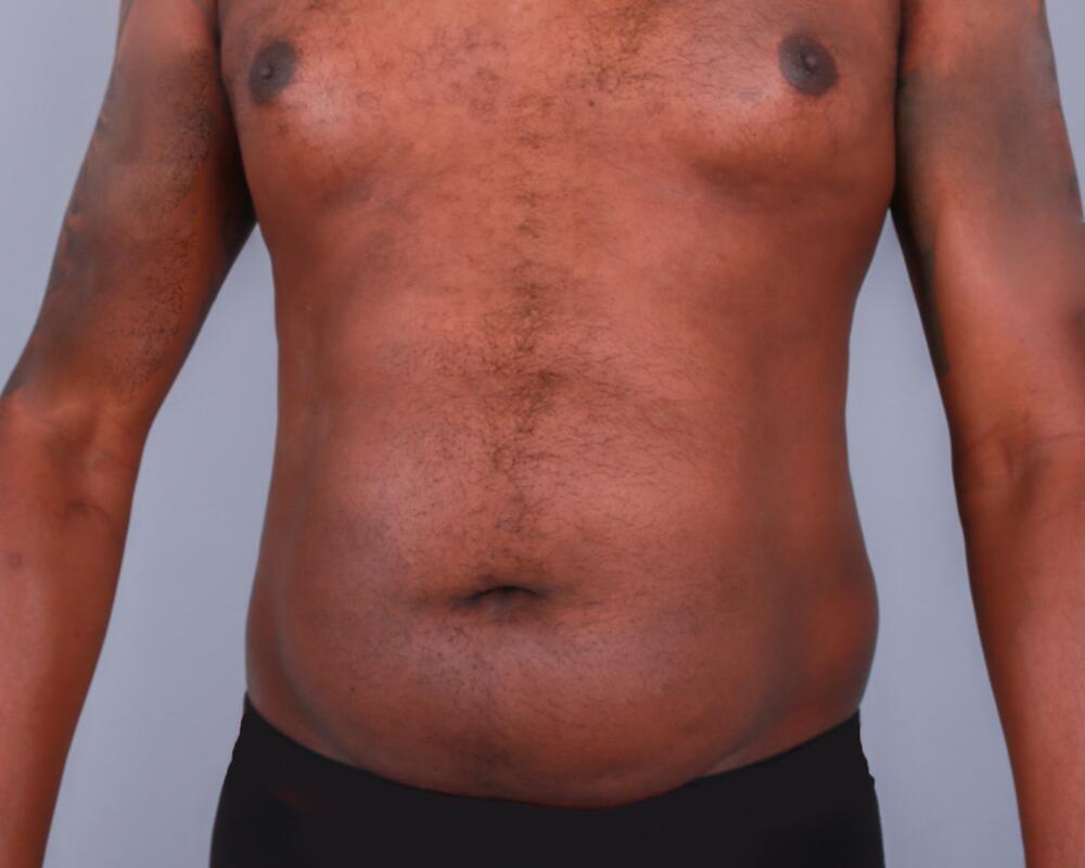 Male Abdominoplasty Before & After Image