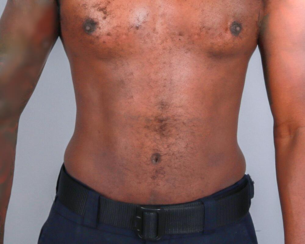 Male Abdominoplasty Before & After Image