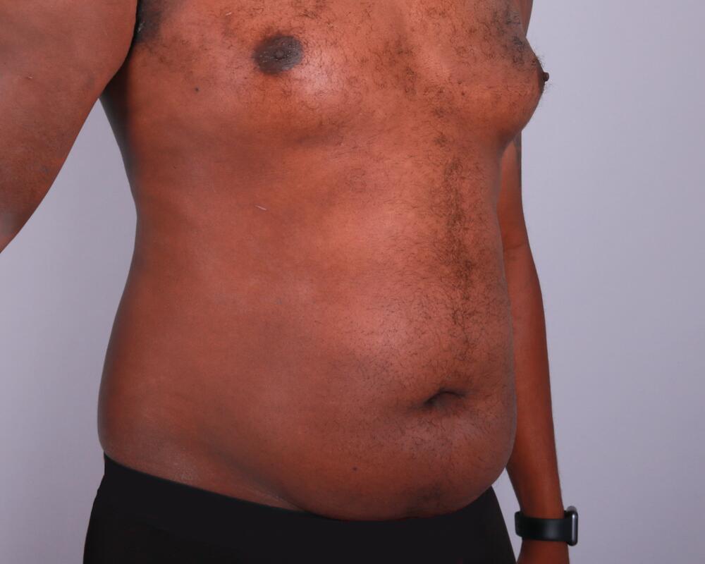 Male Abdominoplasty Before & After Image