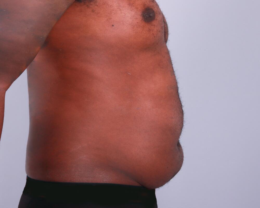 Male Abdominoplasty Before & After Image