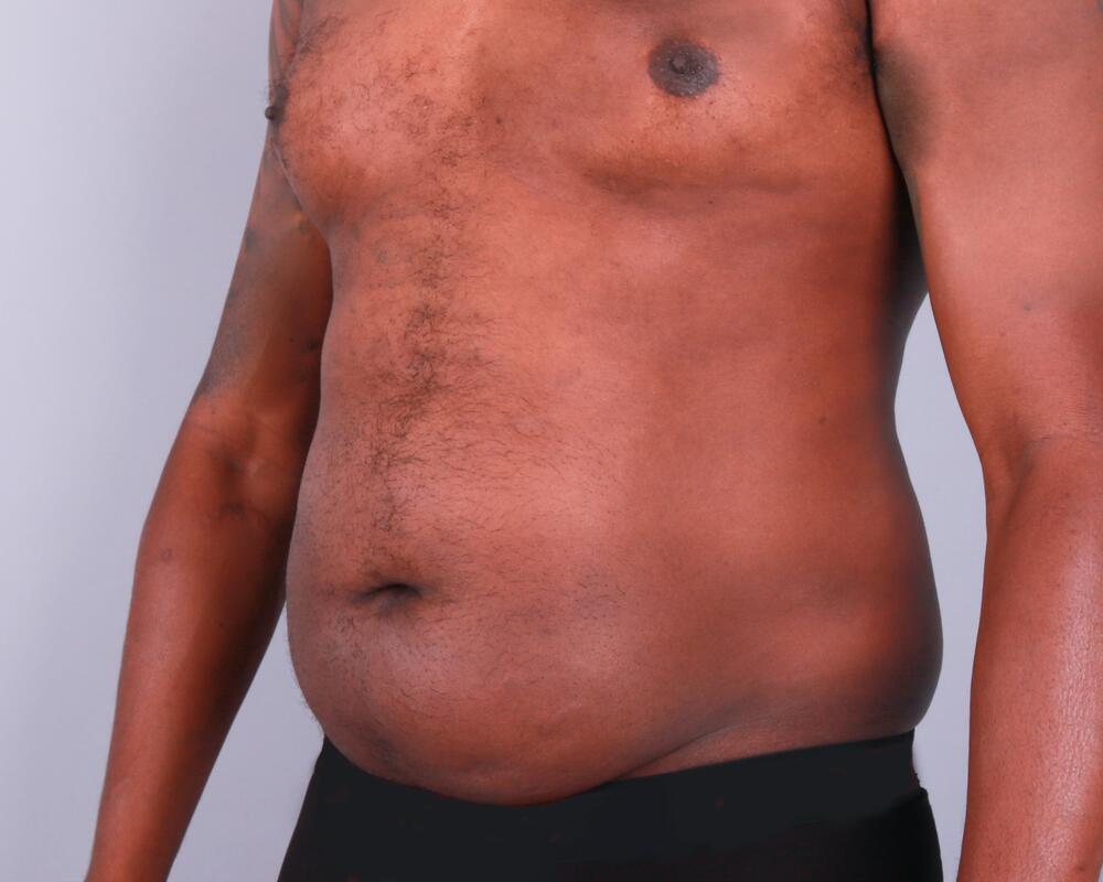 Male Abdominoplasty Before & After Image