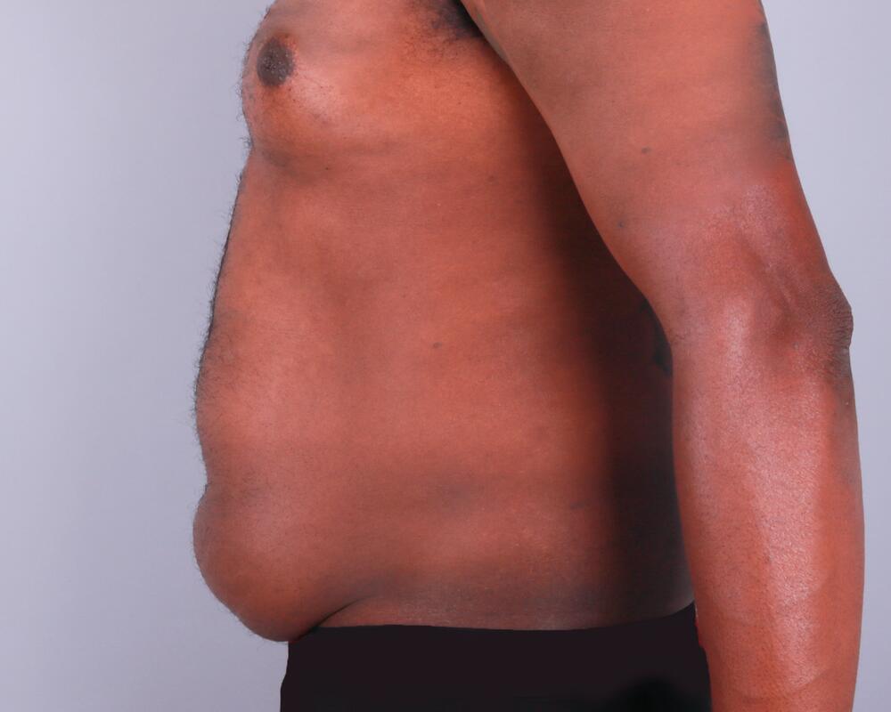 Male Abdominoplasty Before & After Image