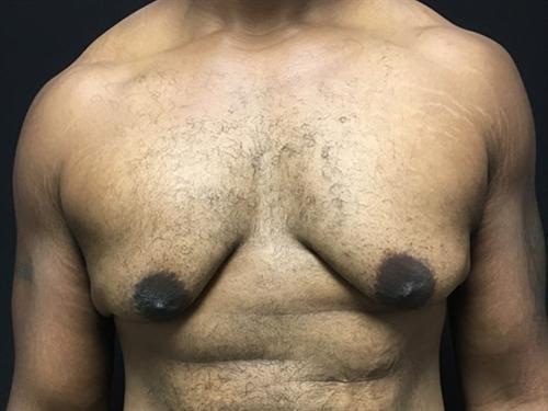 Gynecomastia Surgery Before & After Image