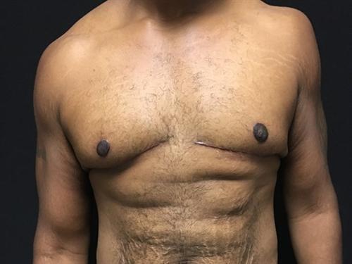 Gynecomastia Surgery Before & After Image