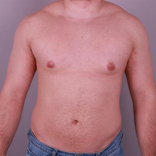 Gynecomastia Surgery Before & After Image