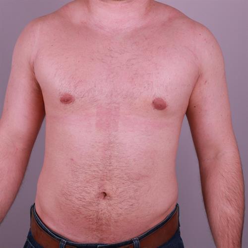 Gynecomastia Surgery Before & After Image