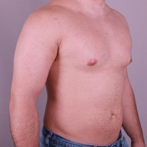 Gynecomastia Surgery Before & After Image