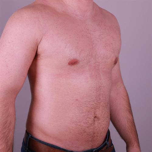 Gynecomastia Surgery Before & After Image