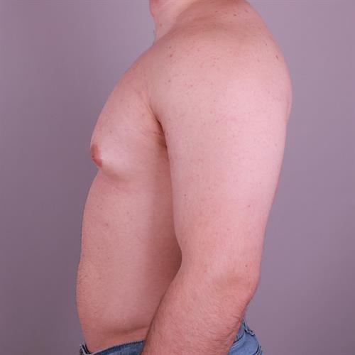 Gynecomastia Surgery Before & After Image