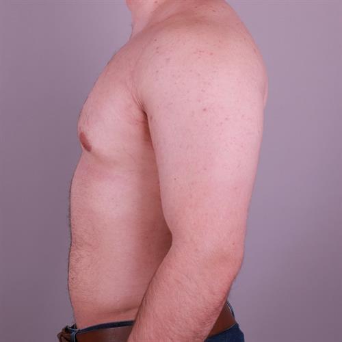 Gynecomastia Surgery Before & After Image