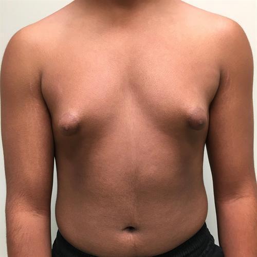 Gynecomastia Surgery Before & After Image