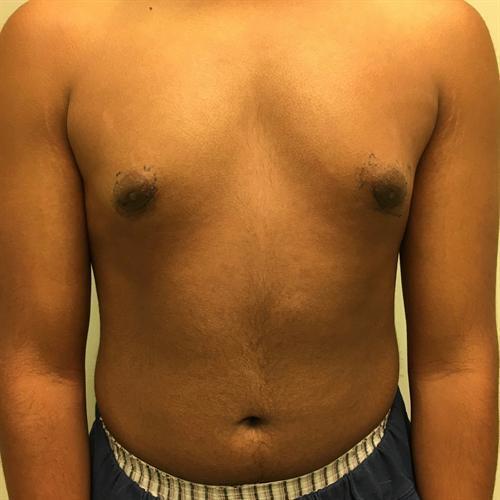 Gynecomastia Surgery Before & After Image