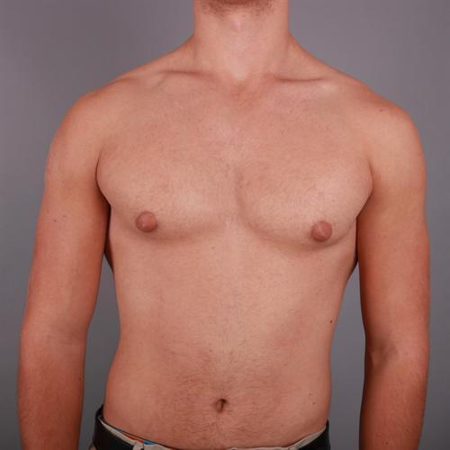 Gynecomastia Surgery Before & After Image