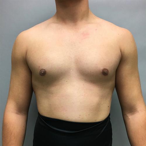 Gynecomastia Surgery Before & After Image