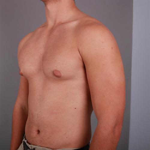 Gynecomastia Surgery Before & After Image