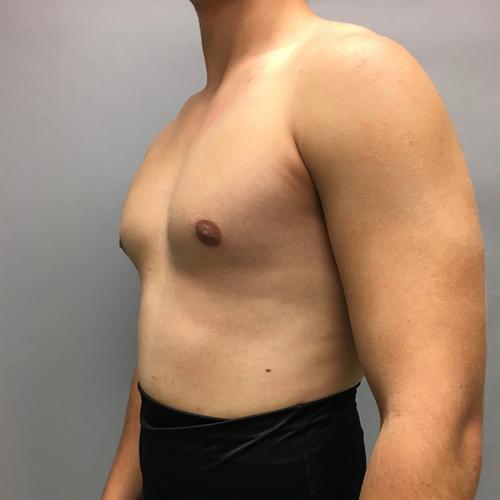 Gynecomastia Surgery Before & After Image